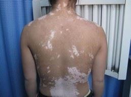 福建泉州洛江区颈部白癜风症状，背部出现白斑的图片